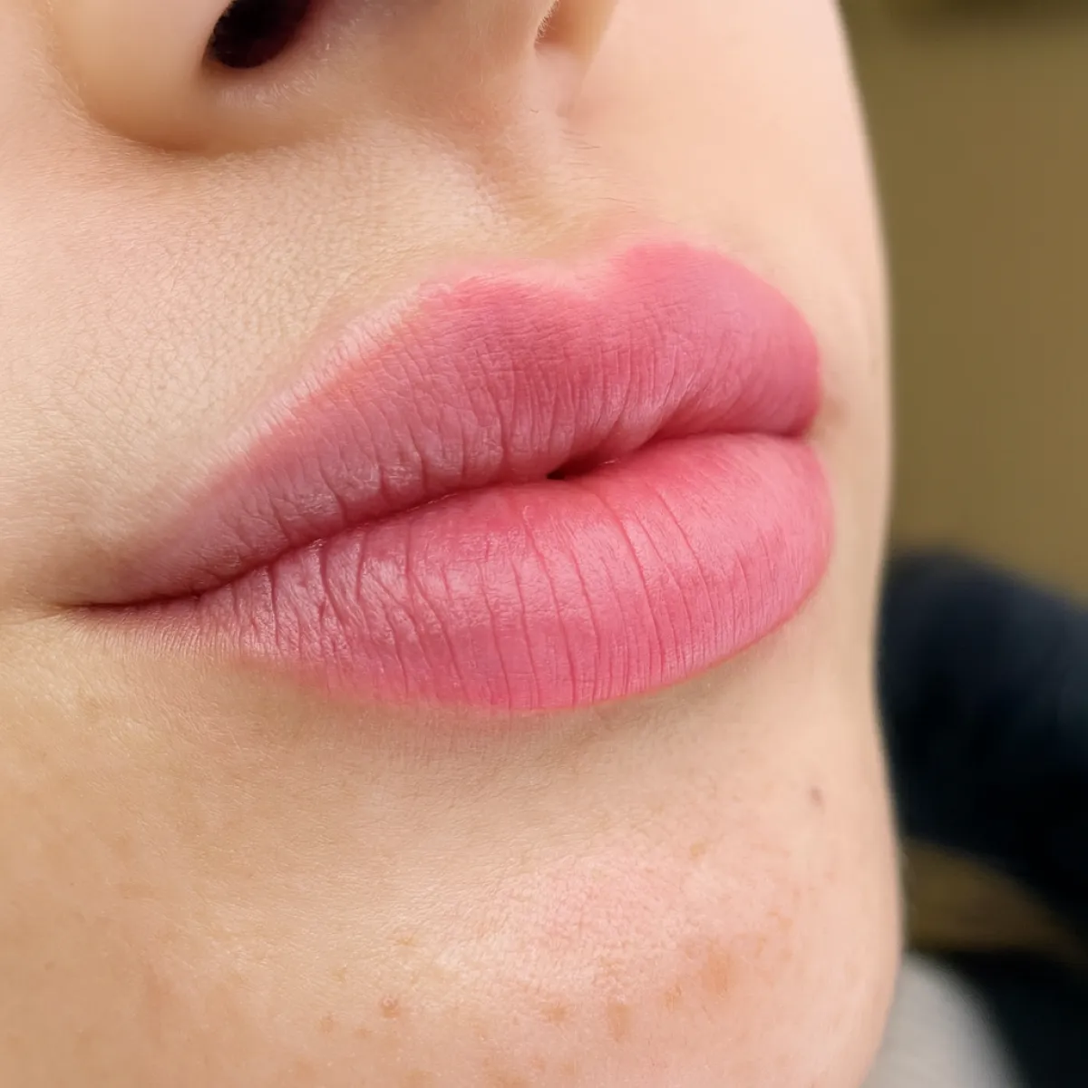 Dudak Gençleştirme